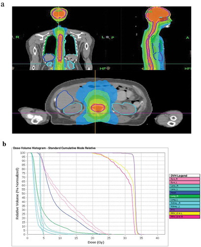 Figure 5. Tomotherapy plan for patient. (a) Axial, coronal, and sagittal distributions for patient, the areas in red received 32.5 Gy. (b) Dose–volume histograms showed OARs were well protected.