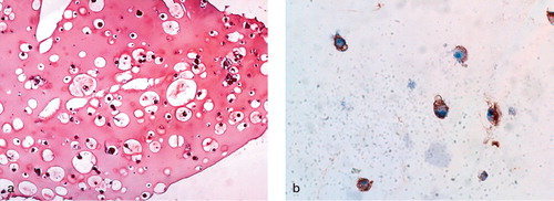 Figure 3. Safranin-O staining and immunohistochemistry for detection of S-100 protein 3 weeks after alginate-fibrin bead culture of perichondrial cells.(a) The alginate-fibrin scaffold is stained positively by Safranin-O (× 100).(b) The perinuclear cytoplasm is immunoreactive for S-100 protein (× 400).