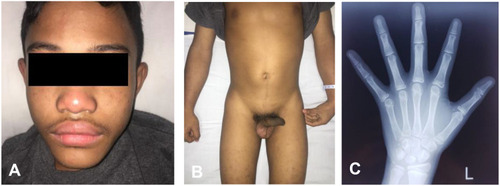 Figure 1 Acne and facial hair (A) and enlarged penis with scant pubic hair (B) in a 6-year-old boy, showing signs of precocious pseudo-puberty as shown on both cases. Advanced bone age of Case 2 (C).