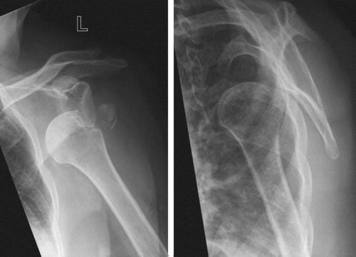 Figure 1. The left shoulder of a 64-year-old patient (no. 3, Table 3), who suffered an anterior glenohumeral dislocation of the left shoulder with an avulsed greater tuberosity.