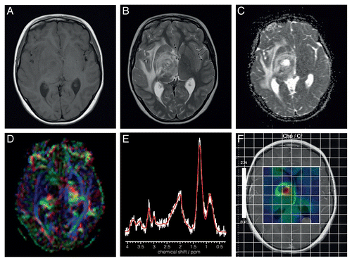 Figure 2 Axial MR images from a patient with a right thalamic high grade glioma acquired at 1.5T (A) T1-weighted; (B) T2-weighted; (C) DWI; (D) fractional anisotropy image (E) 1H MRS from the tumor core with major peaks assigned as follows: Choline-containing compounds (3.23ppm), total creatine (at 3.03 ppm) and mobile lipids (at 2.0, 1.3 and 0.9 ppm); (F) Choline-containing compounds-to-total creatine (Cho/Cr) ratio image from multivoxel MRS represented as a color map on a T1-weighted image acquired after injection of a Gd-contrast agent.