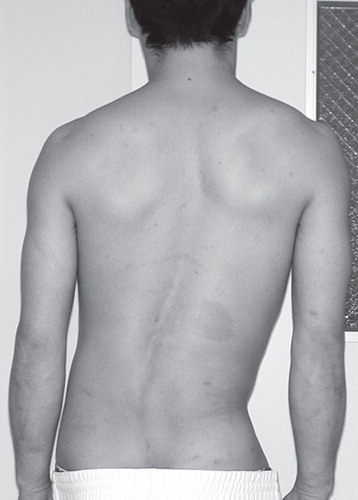 Figure 1. Preoperative clinical photography revealed significant scoliosis.