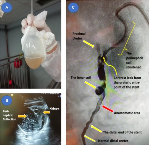 Figure 6 Pig 3 (A) Fluid Collection. (B) US with perinephric collection demonstrated. (C) Contrast study showing the extravasation of contrast at the entry point of the stent to the ureter with the inner coil stretching the ureter distally and the perirenal coil partially dislodged.