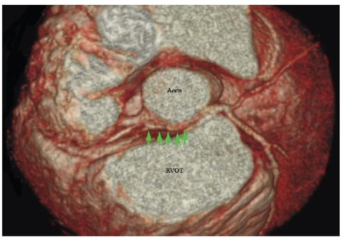 Figure 4 Three-dimensional reconstructed, volume rendered computed tomography coronary angiography showing the course of the anomalous left main coronary artery (green arrows) arising from the right coronary cusp then traversing between the aorta and right ventricular outflow tract (RVOT).