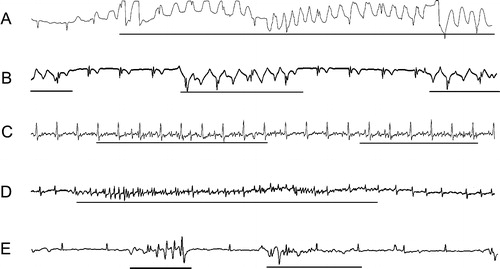 Figure 1. Examples of ECG recordings distorted by artefact provocations. Lines below the tracings indicate artefactual ECG. A and B: slight touching of the skin electrodes. C and D: teeth-brushing. E: rotation of the arms. In recording A, for example, some parts of the ECG are valueless for interpretation because of the concealment of ordinary P waves and QRS complexes. In recording B, QRS complexes but not P waves can be discerned.