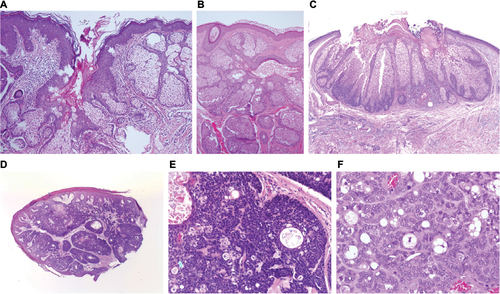 Figure 11 Tumors with sebaceous differentiation.