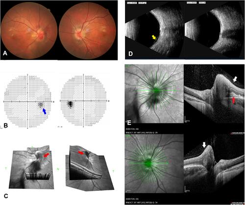 Figure 4 Follow-up of Case 2 for 2 weeks without any treatment. (A) Partially resolved hemorrhage. (B) Normalized visual field examination (blue arrow). (C) Temporal inclined optic disc with nasal protrusion revealed by three-dimensional OCT reconstruction (red arrows). (D) Continuous posterior detachment of vitreous body and adhesion to nasal side of optic discovered by B-ultrasonography (yellow arrow). (E) Local PVD with tight adhesion to the raised nasal optic disc on OCT (white arrows), subretinal bleeding (red arrow).