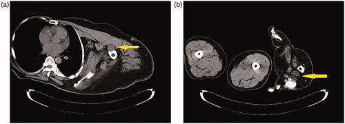 Figures 5. (a,b) MRI: MRI showed increased T2 signal in the interior of the median nerve, suggesting the presence of fat. The median nerve was enlarged of both upper extremities. Especially, adipose hyperplasia was salient in the carpal tunnel.