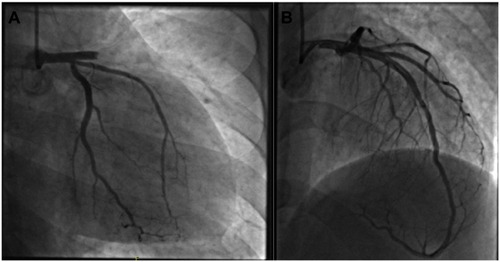 Figure 2 (A) RAO 20-caudal 20 view left coronary angiography: proximal LAD thrombus and thrombolysis in myocardial infarction (TIMI) flow grade 0. (B) RAO 10-cranial 40 view: a 4.0×22 mm drug-eluting stent was placed in the proximal LAD to restore normal TIMI flow grade 3. Right coronary angiography (not shown) was normal.