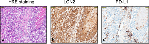 Figure 3 Expression of LCN2 and PD-L1 in Triple-Negative Breast Cancer (TNBC). (a) Representative H&E staining of TNBC, (b) LCN2 staining of tumor cells (Allred score 7 with cytoplasmic staining of the same area in a, (c) PD-L1 staining in tumor cells and lymphocytes (CPS 50, same area in (a and b). All figures are at 100 µm magnification.