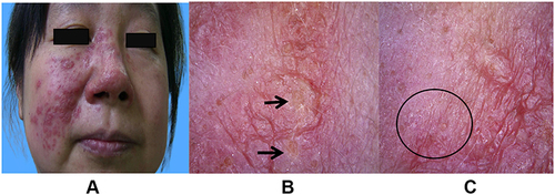 Figure 2 Two weeks of treatment: the red swellings and papules started gradually subsiding, and the pustules had disappeared (A); dermoscopy showed yellowish, structureless areas turned into yellow dots ((B), black arrow) on a bright red background, and “fried eggs” had disappeared; vellus hair loss persisted in some lesions ((C), black circle).