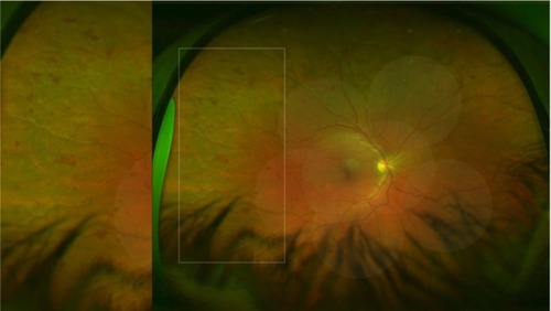 Figure 2 Optomap UWFSLO image showing a retina with predominantly peripheral lesions outside the ETDRS seven-field view.