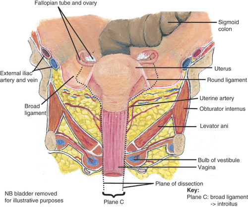 Figure 2. Frontal view of dissection planes.