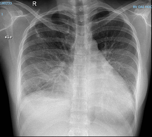 Figure 8 Chest radiograph before discharge, demonstrating enlargement of the cardiac silhouette.