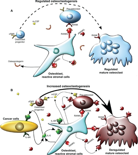 Figure 1 Model of osteoclastogenesis during bone homeostasis and tumor cell metastasis to bone. A) In normal bone, RANKL and m-CSF are produced primarily by osteoblasts. m-CSF binds to its receptor c-FMS, expressed on osteoclast progenitors, and RANKL binds to its receptor on pre-osteoclasts to promote osteoclastogenesis. Osteoprotegrin, also produced by osteoblasts, acts as a decoy receptor for RANKL and negatively regulates osteoclast differentiation. In this model, osteoblast and osteoclast activity are in homeostasis through careful regulation of osteoclastogenesis. B) When cancer cells metastasize to the bone, increased IL-6 may be produced by both the cancer cells and the osteoblasts, as an inflammatory response to the cancer cells. IL-6 then stimulates various types of stromal cells in the bone, which include bone marrow cells, osteoblasts, and fibroblasts in the area of the metastasis, to increase the expression of RANKL and m-CSF by osteoblasts. This IL-6-mediated increase in RANKL and m-CSF also occurs with injury and inflammation to the bone, but unlike in cancer metastasis, it is transient. RANKL and m-CSF then, in turn, activate the osteoclast differentiation cascade, where m-CSF strongly stimulates early stages of osteoclast differentiation, and RANKL stimulates late stages of osteoclast differentiation, as well as osteoclast activity. Once this occurs, osteoclast activity becomes dysregulated and reduces bone integrity.Abbreviations: c-FMS, colony stimulating factor 1 receptor; IL-6, interleukin 6; IL-6R, IL-6 receptor; m-CSF, macrophage-colony stimulating factor; RANKL, receptor activator of nuclear factor κB ligand; sRANKL, soluble form of RANKL.
