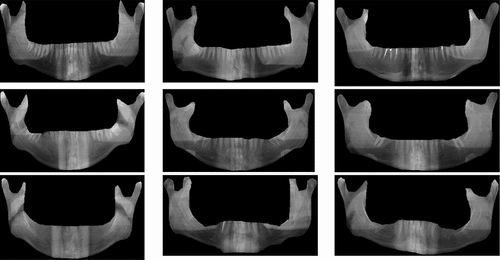 Figure 20. Sample image dataset containing segmented X-ray dental images for training DNN based on CNN for classification as ideal edentulous, partially damaged edentulous and completely damaged edentulous cases.