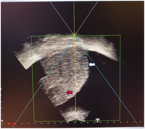 Figure 3. HIFU sonographic image of a patient with preexisting ascites and segment 6 HCC (red arrow). The patient is lying in the right-lateral position. The ascites has separated the liver dome (white arrow) from the diaphragm, allowing excellent sonographic visualization of the liver dome.