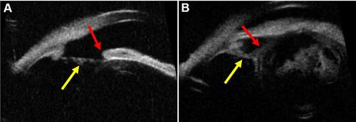 Figure 2 Ultrasound biomicroscopic (UBM) images illustrating zonular stretching ((A and B) Yellow arrow) in the presence of iridodialysis (A; Red arrow) in a 63-year-old patient with blunt trauma and anterior subluxation of the cataractous lens (B; Red arrow) in a 33-year-old patient with blunt trauma.