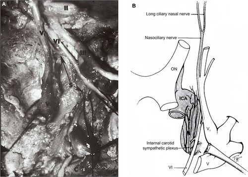 Figure 3 (A) Cadaver dissection showing oculosympathetic fibers (S) attaching (lower arrow) to the abducens nerve (VI) within the cavernous sinus. After running with the nerve for a short distance, they separate from the nerve (upper arrow) and join with the first division of the trigeminal nerve (V1) to enter the orbit.