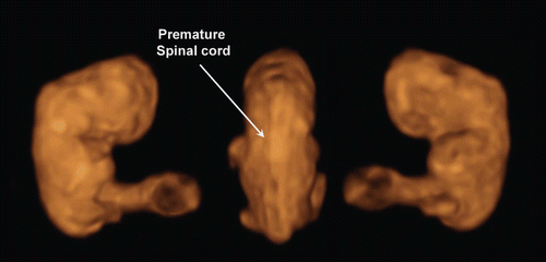 Figure 3.  3D reconstructed image of the embryo (8 weeks of gestation). Normal 8-week-embryo. Occipital view shows the premature spinal cord which is seen in the Figure 4 (right).