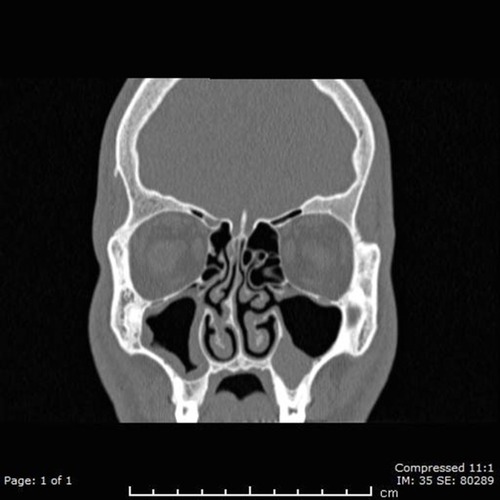 Figure 2 Paranasal CT scan demonstrated left accessory ostium with bilateral sinusitis.