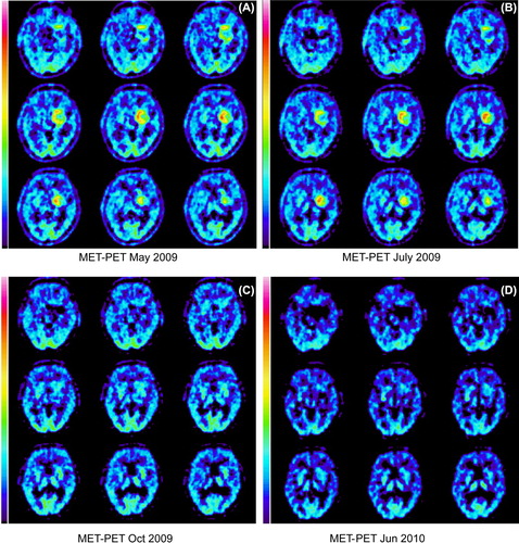 Figure 1.(A-D): 11C-methionine PET scans before and during chemotherapy. (A) In May 2009 after extensive radiotherapy, but before drug therapy, the scan showed enhanced uptake of methionine. (B) A treatment attempt with erlotinib in combination with cetuximab was made. Nevertheless, a slight increase in uptake was detected in July. (C) A clear reduction, even to subnormal levels, of methionine uptake in October compared to the previous exam was seen after replacement of cetuximab by bevacizumab, while erlotinib treatment continued. (D) The combination of erlotinib and bevacizumab continued until June 2010. The same month the methionine uptake level was unchanged compared to C.
