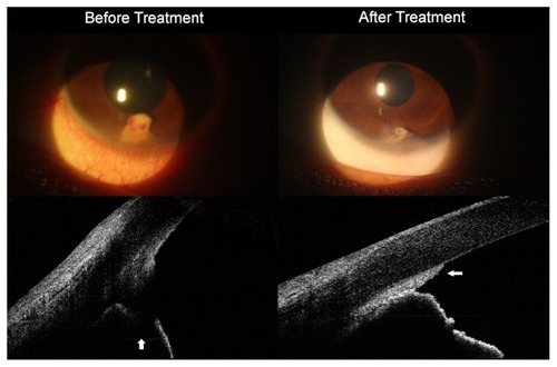 Figure 3 Vertical scans of anterior segment SD-OCT images of pearl-like lesion at the anterior chamber at 6 o’clock.