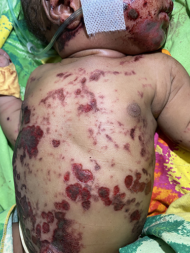 Figure 3 The newborn, miraculously surviving being buried alive, displays scattered abrasions and bruises. Photographed in the emergency department after thorough soil removal, the infant was placed under a radiant warmer to prevent hypothermia.
