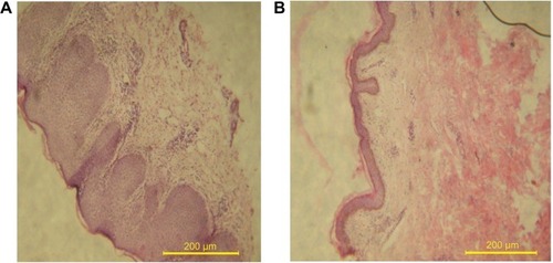 Figure 7 Patient’s skin histology.