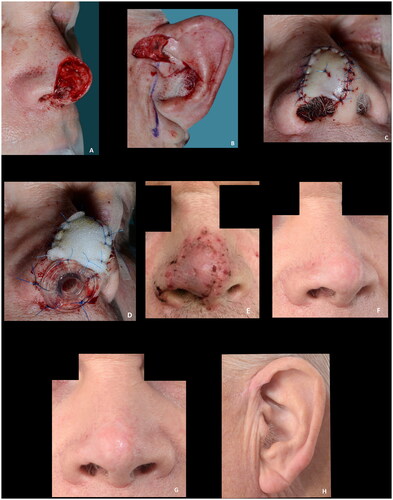 Figure 8. (A–D) A large superficial defect with a smaller full thickness defect measuring 4 × 12 mm, providing a well-vascularized recipient site for graft take. Note the nasal airway secured to maintain the airway, eliminate dead space, immobilize the graft and to preserve the shape of the nasal ala while the graft heals. (E) The result at the first dressing change seven days postoperative. (F–H) Fourteen months postoperative showing results rated as good. Courtesy of consultant, plastic and reconstructive surgeon Jais Oliver Berg, Dep. of Plastic Surgery, Herlev and Gentofte Hospital, Denmark.