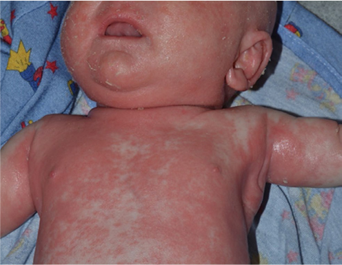 Figure 2 Neonate with Netherton syndrome.