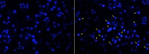 Figure 6 DAPI staining approved the apoptotic effects of the silver nanoparticles on the breast cancer cells regarding the infiltration of the nucleus by the dye (arrows).