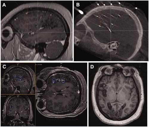 Figure 3. sEEG-guided ablation of insulo-opercular epilepsy. (A) sEEG trajectory planning; (B) post-sEEG implantation CT demonstrating electrode contact corresponding to the seizure onset zone; (C) intra-ablation MR thermography demonstrating ablation of the insulo-opercular target. (D) Postoperative (3 months) T1-weighted MR image showing insulo-opercular lesion.