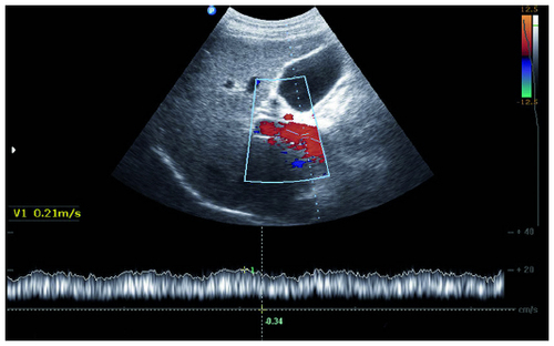 Figure 2 Duplex Doppler sonography of the portal vein in a healthy control subject with continuous hepatopetal flow.