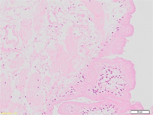 Figure 4 The histology structures of plerocercoid from the thigh was a characteristic thick eosinophilic uniform tegumental structure of sparganum with underlying stout muscle bundles (H&E stain, ×200).