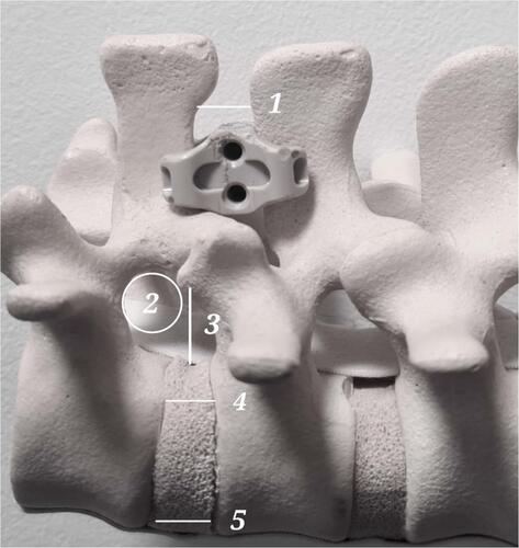 Figure 2 IPD model—points of interest at the level of IPD implantation, 1 – interspinous distance, 2 – intervertebral foramen surface area, 3 – foraminal diameter, 4 – vertebral height posterior part, 5 – vertebral height anterior part.