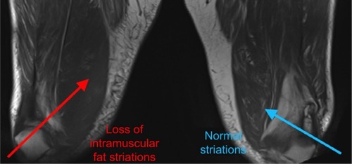 Figure 2 Coronal T1 (non-fat saturated) MRI scan demonstrates right sided muscular swelling combined with subtle loss of the intramuscular fat striations (red arrow) when compared with the contralateral side (blue arrow).