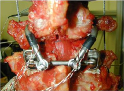 Figure 1 Flexion–extension movements of intact vertebrae after ligament resection, facet (zygomatic) joint removal, and stabilization with the new implant.