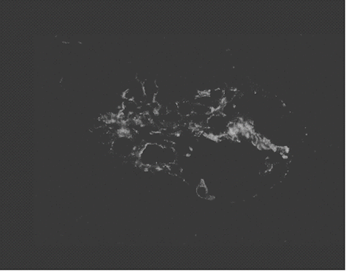 Figure 2. Immunofluorescence demonstrated IgA-postive staining in mesangium area.