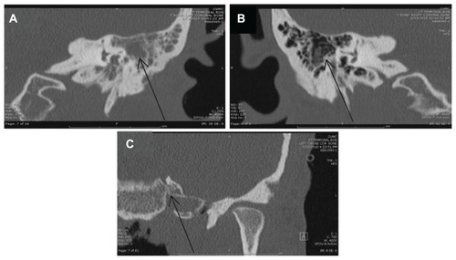 Figure 1 Imaging of the mastoid processes, demonstrating left otomastoiditis: (A) preoperative temporal bone computed tomography (CT) performed on January 13, 2010, and showing left-sided otomastoiditis with opacification (arrow indicates inflamed mastoid air cells); (B) preoperative temporal bone CT performed on January 13, 2010, and showing normal right-sided mastoid air cells without opacification (arrow indicates comparable area that shows the normal appearance of mastoid air cells); (C) postoperative temporal bone CT performed on February 19, 2010, and showing postoperative and postantibiotic resolution of left-sided otomastoiditis (arrow indicates the original area). Note: Some parts of the mastoid process were removed intraoperatively.