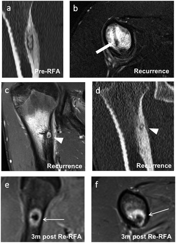 Figure 5. Images of a 16-year-old male with a recurrent osteoblastoma of the right humerus. (a) Coronal reformation of a CT scan performed at the time of diagnosis. (b) Axial T2-weighted fat-saturated image taken at the time of the second clinical recurrence showing extensive perifocal bone marrow edema and the former drilling channel (thick arrow) located cranially and laterally to the recurrent active nidus. (c) Coronal T1-weighted fat-saturated contrast-enhanced image of the same exam as in (b) showing strong contrast enhancement of the central nidus (arrowhead). (d) Coronal reformation of a CT scan performed at the time of the second recurrence showing an active centrally mineralized nidus (arrowhead) in the cranial segment of the initial osteoblastoma. (e, f) Coronal and axial T1-weighted fat-saturated contrast-enhanced images taken 3 months after the third RFA. A typical target-like appearance is seen with a non-enhanced central nidus surrounded by an enhanced peripheral nidus (thin arrows). Only a small degree of perifocal bone marrow edema is visible. RFA: radiofrequency ablation.