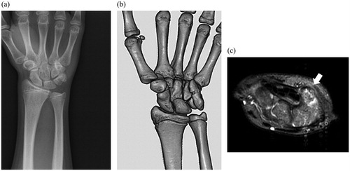 Figure 1. (a) Plane X-ray before the surgery (b) 3D reconstruction CT scan before the surgery (c) T2 image of MRI; white arrow indicates pisiform.