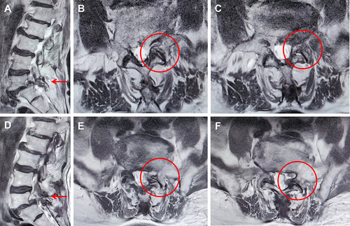 Figure 4 Preoperative and postoperative MRI (magnetic resonance imaging) scans. (A–C) Preoperative MRI indicating the left L5 pars defect (red arrow) and L5-S1 foramen stenosis (red circle). (D–F) Postoperative MRI revealing foramen enlargement (red arrow) and liberation of the left L5 exiting nerve root (red circle).
