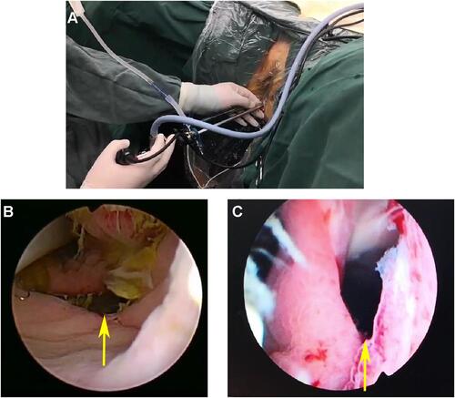 Figure 1 (A) 26.5-Fr (diameter, ~8 mm) prostate resectoscope was inserted into the rectum through the anus (A). Anastomotic fistula (yellow arrow) seen under prostate resectoscope (B, C).