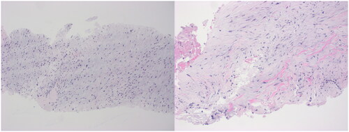 Figure 2. Histological examination showed haphazardly arranged spindle to stellate cells arranged in a myxoid matrix with mucin pools. FISH analysis revealed the presence of a USP6 rearrangement.