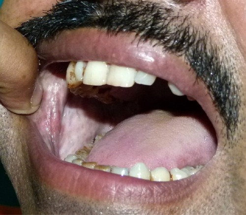Figure 3 Blanching of buccal mucosa in oral submucous fibrosis.