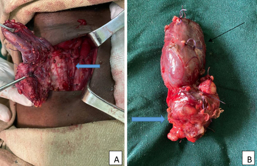 Figure 2 (A) Intra-operative image of the parathyroid adenoma and left lobe of thyroid gland, preserved left recurrent laryngeal nerve (arrow), (B) the resected specimen; left lobe of thyroid (thin arrow) and left inferior parathyroid adenoma (thick arrow).