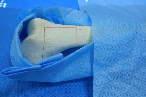 Figure 2 The conventional method: A standard procedure for wide resection in orthopaedic oncology in which surgeons tried to reproduce the osteotomy lines in reference to known palpable/visible external landmarks on the bone, and draw the three osteotomy line segments on the bone using a marking pen to reproduce the preoperative plan.