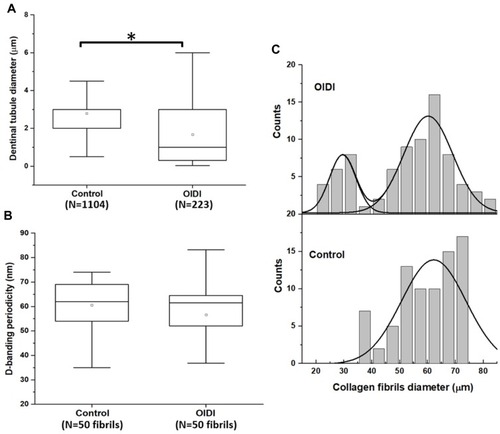 Figure 4 Graphical presentation of the nanoscale phenotypic properties (structural) for control and OIDI dentin: (A) boxplots of the measured dentinal tubules diameter (*significance p<0.05). (B) Boxplots of the measured collagen fibrils D-banding periodicity (no significant differences were observed). (C) Fitted histograms of the collagen fibril diameter with bimodal distributions (Gaussian) for OIDI collagen (R2>0.9) and for control collagen (R2>0.8).