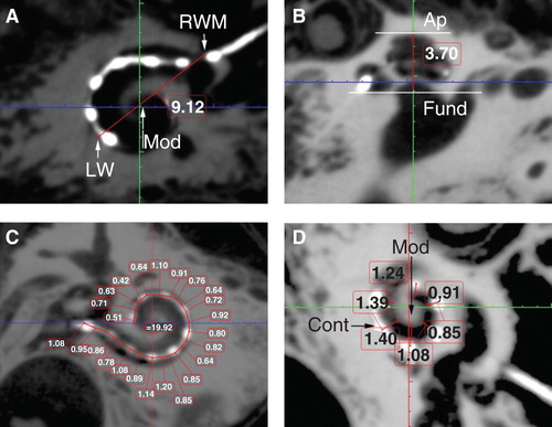 Figure 4. Critical cochlear assessments on cone-beam computed tomography (CBCT) images. ‘A’ value (A), cochlear height (B), insertion depth for the first 360° insertion angle (C), and distance between the electrode contacts and the modiolus (D) are demonstrated (in mm). Ap, apex; Cont, contours of cochlear implant; Fund, fundus; LW, lateral wall; Mod, modiolus; RWM, round window membrane.